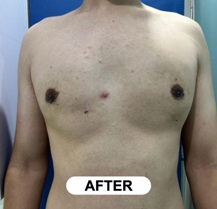 After Gynecomastia Surgery